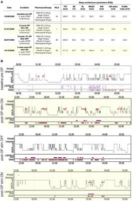 Spinal cord stimulation in severe pharmacoresistant restless legs syndrome—two case reports